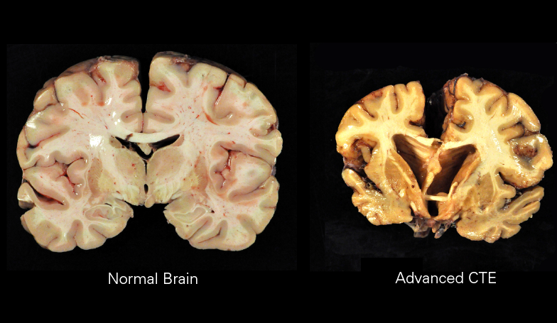 Concussions in the brain dead games